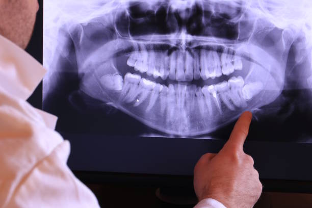 Best Emergency Wisdom Teeth Removal in Maywood, NJ